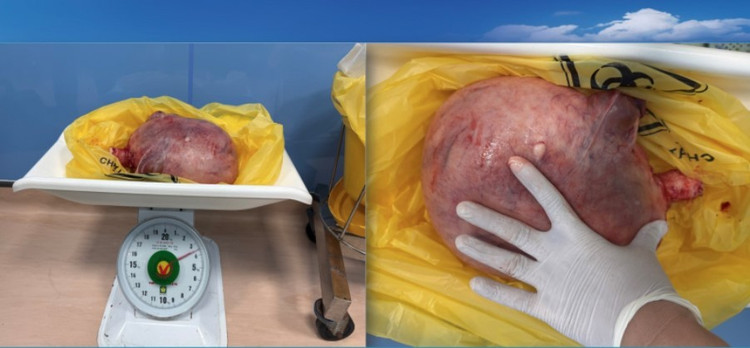 Khối u nặng 3,5kg được cắt bỏ - Ảnh BVCC u-xo-to.jpg