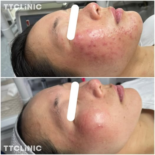 Bệnh trứng cá đỏ - Ảnh minh họa nguồn Internet trung-ca-do.jpg