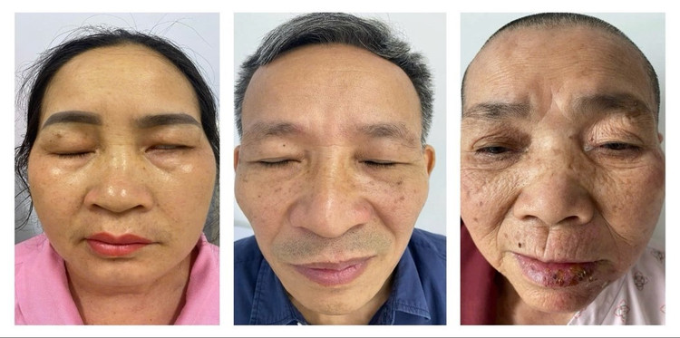 Hình ảnh một số bệnh nhân Zona biến chứng liệt mặt đã điều trị tại Khoa Da liễu – Bệnh viện TWQĐ 108 liet-mat.jpg
