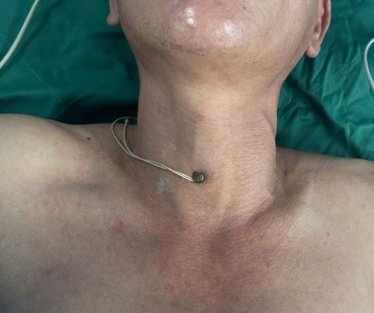 Người đàn ông bị dị vật đinh sắt đâm giữa cổ - Ảnh BVCC xuyen-thau-3.jpg