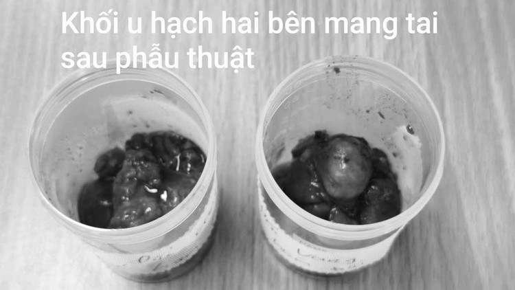 Khối u hạch hai bên được lấy ra - Ảnh BVCC khoi-u-mang-tai.jpg