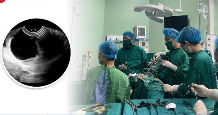 Ê- kíp phẫu thuật cho bệnh nhân - Ảnh BVCC u-nang-ong.jpg