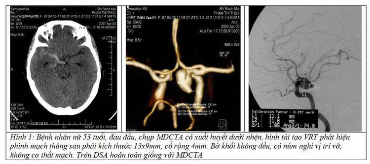 Bệnh nhân vỡ phình mạch máu não do đau đầu - Ảnh BSCC anh-2.jpg