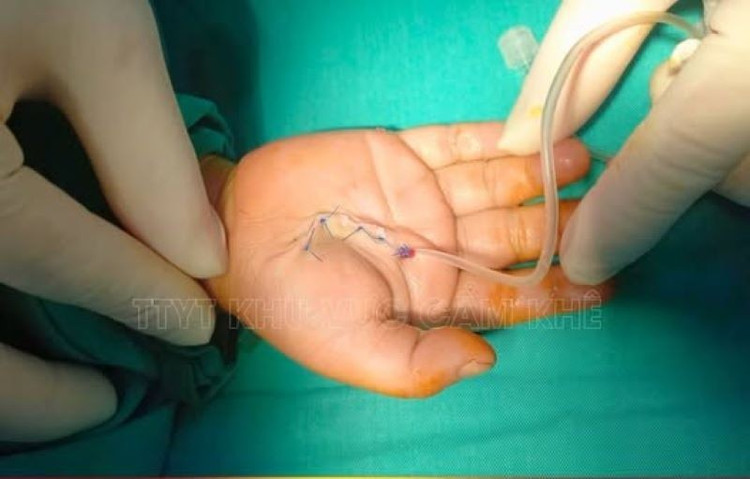 Trẻ bị mảnh thủy tinh làm đứt gân ngón tay phức tạp - Ảnh BVCC manh-vo-thuy-tinh.jpg
