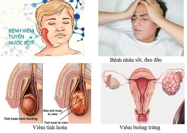 Biểu hiện của bệnh - Ảnh BVCC quai-bi-1.jpg