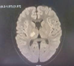 Hình ảnh chụp MRI não bộ của trẻ khi có dấu hiệu đột quỵ - Ảnh BVCC dot-quy-tre-1.jpg