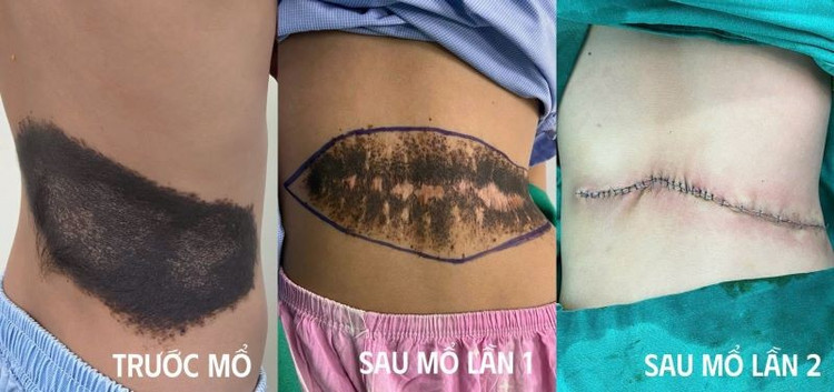 Kết quả sau 2 lần mổ - Ảnh BSCC u-sac-to-4.jpg