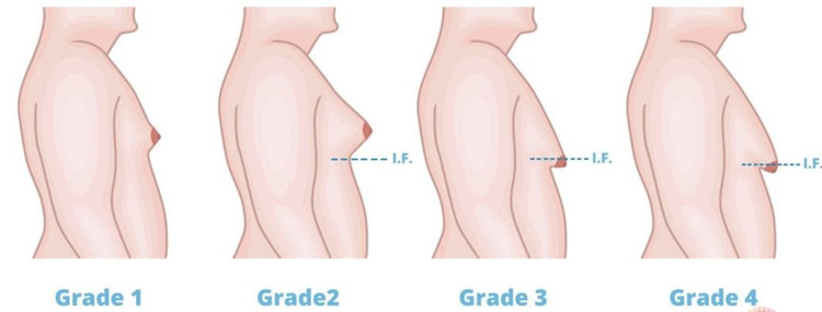 Classification of male breast hypertrophy - Photo BVCC phi-dai-1.jpg