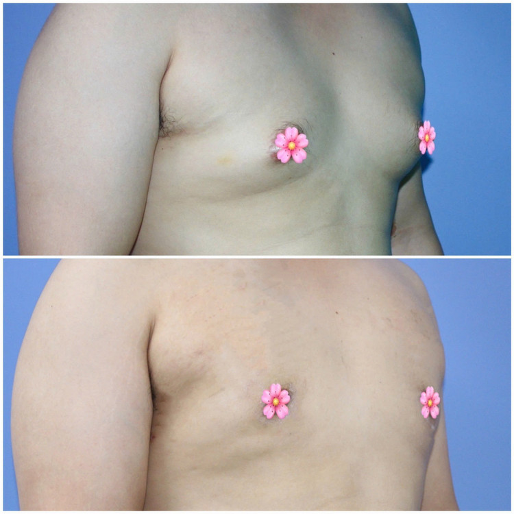 Breast hypertrophy patient before and after surgery - Photo: BVCC phi-dai-2.jpg