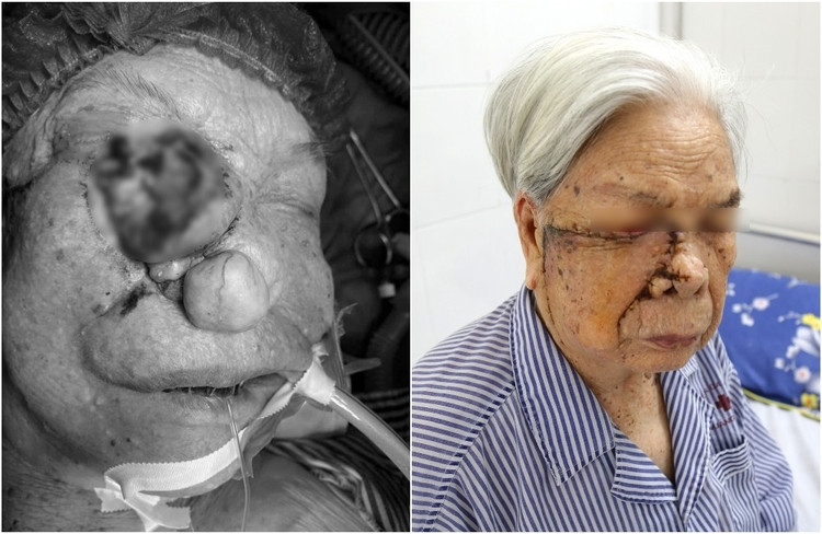 Khối u của bệnh nhân trước và sau phẫu thuật - Ảnh BVCC u-lon-mat.jpg