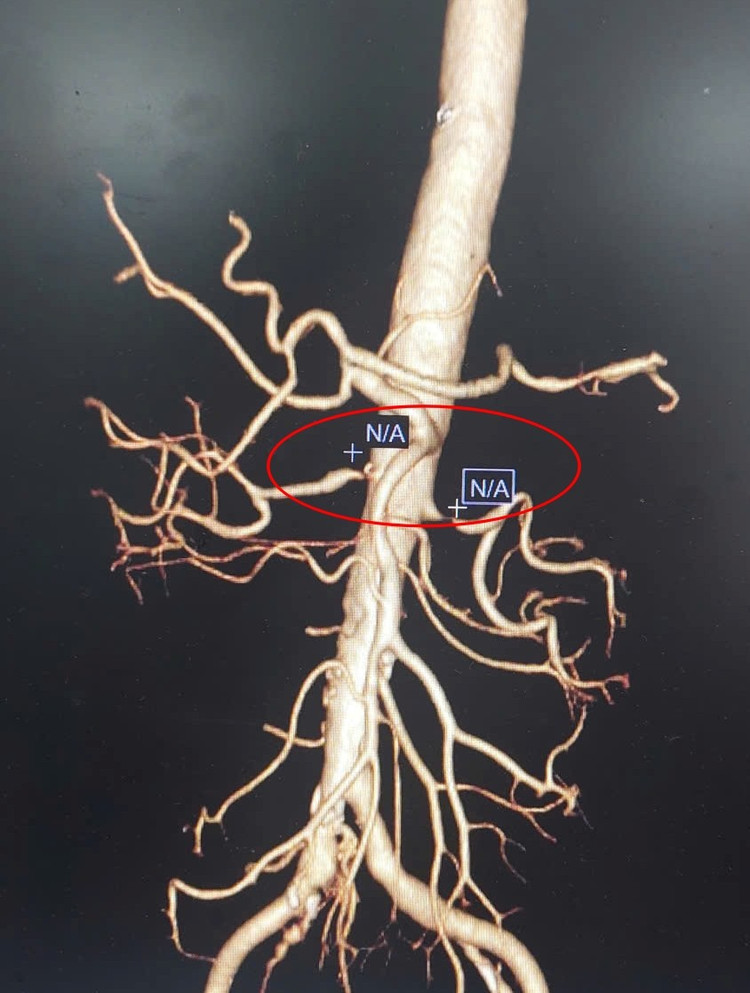 Hình ảnh CLVT dựng hình 3D động mạch thận hai bên hẹp tắc nặng - Ảnh BVCC stent-huyet-ap.jpg