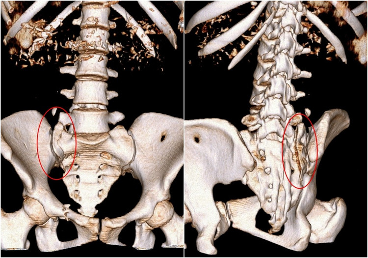 Dựng hình 3D phần gãy phức tạp cánh xương cùng - Ảnh BVCC gayxuongcung.jpg