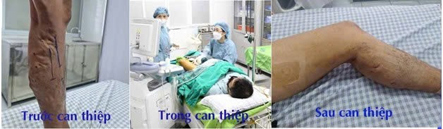 Chân của người bệnh V. trước, trong và sau khi được can thiệp - Ảnh BVCC suy-gian-1.jpg