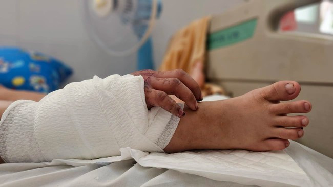 Bàn tay được nối vào chân sản phụ - ảnh BVCC tay-2.jpg