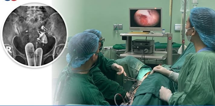 Các bác sĩ thực hiện phẫu thuật tách dính buồng tử cung cho bệnh nhân - Ảnh BVCC tach-dinh-buong-tu-cung.jpg