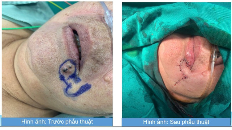 Tổn thương trước và sau phẫu thuật - Ảnh BVCC ut-da-1.jpg