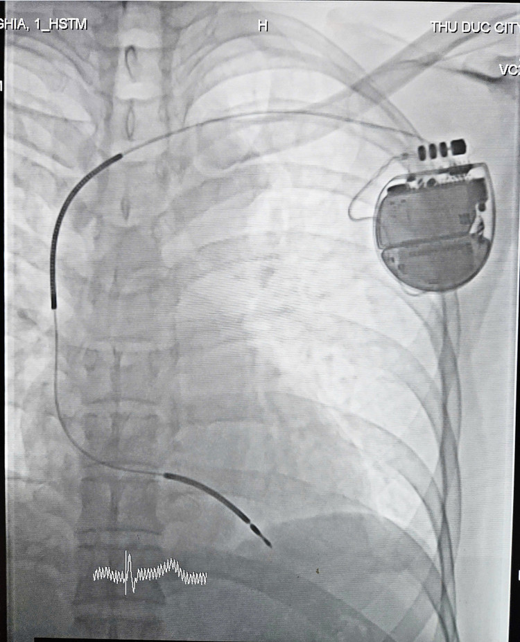 Máy phá rung ICD cấy dưới da - Ảnh BVCC cay-may-pha-rung-1.jpg