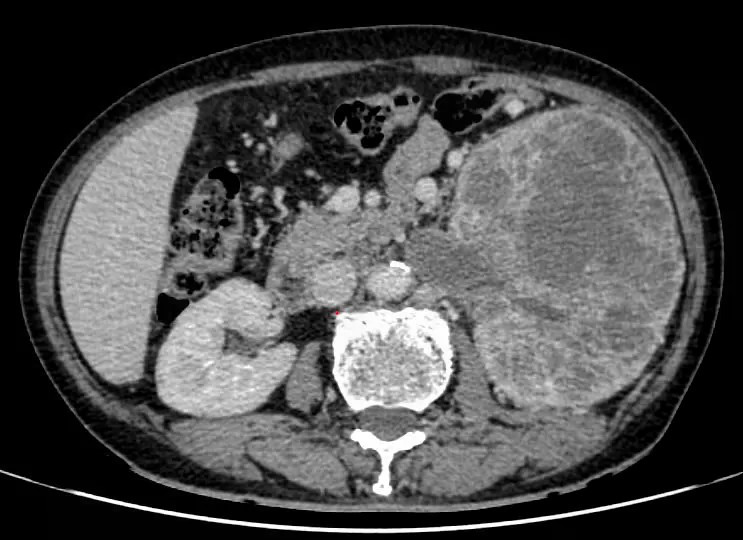 Hình ảnh chụp CT khối u ở thận xâm lấn tĩnh mạch chủ dưới - Ảnh BVCC than1.jpg