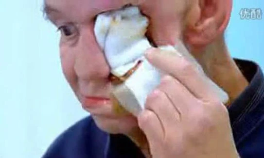 Kinh hoàng người đàn ông bị khoét nửa mặt vì ung thư