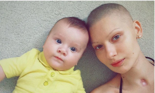 Ảnh tuyệt đẹp người mẫu bị mất hàm vì ung thư xương