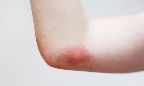 Kinh ngạc những trường hợp viêm sưng có lợi cho cơ thể