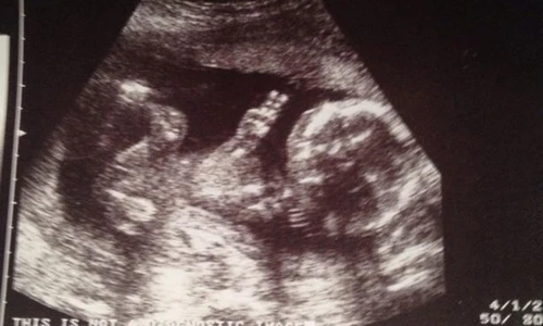 Những hình ảnh siêu âm thai bá đạo nhất quả đất