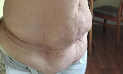 Tận mục cơ thể nhăn nhúm phát sợ do giảm cân quá nhiều