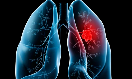 Ung thư phổi ở đàn ông và đàn bà khác nhau thế nào?