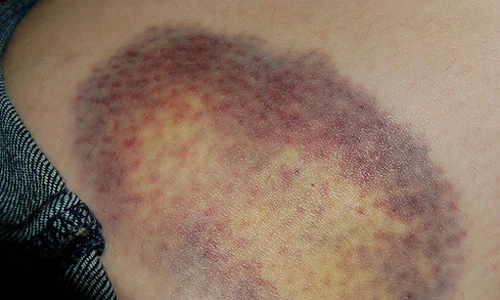 Mẹo làm mờ vết thâm tím cực nhanh