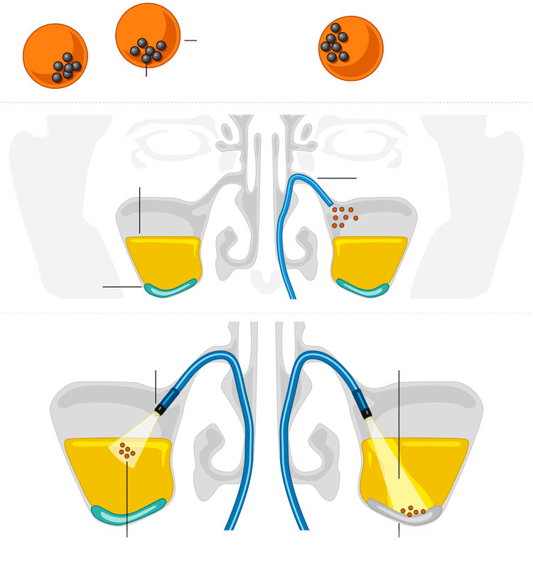 Как работает микроробот при лечении синусита? sinus-microrobots-inarticle-620.png
