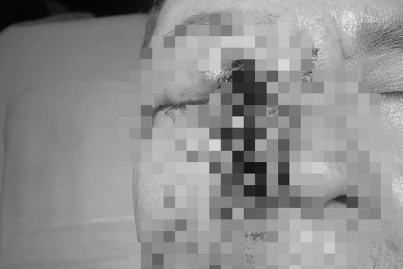 Người đàn ông bị dị vật kim loại đâm vào mắt