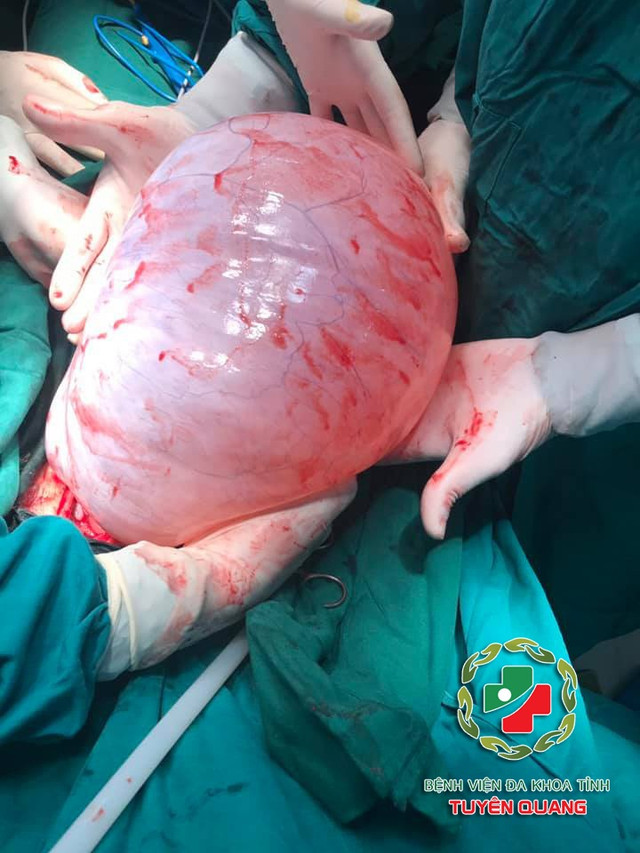 Phẫu thuật thành công cho cô gái 22 tuổi mang khối u buồng trứng gần 8kg - Hình 2 Phau thuat thanh cong cho co gai 22 tuoi mang khoi u buong trung gan 8kg-Hinh-2