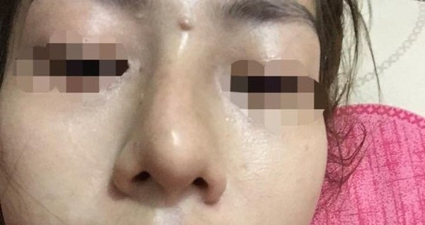 6. Mũi biến dạng: Khi nhìn trong gương thấy mũi khác bình thường thì cũng nên cẩn trọng.