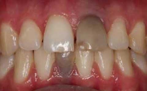 4. Hàm răng khô, dần chuyển sang sắc đen: Răng chuyển sang đen có thể là dấu hiệu của bệnh ung thư miệng.