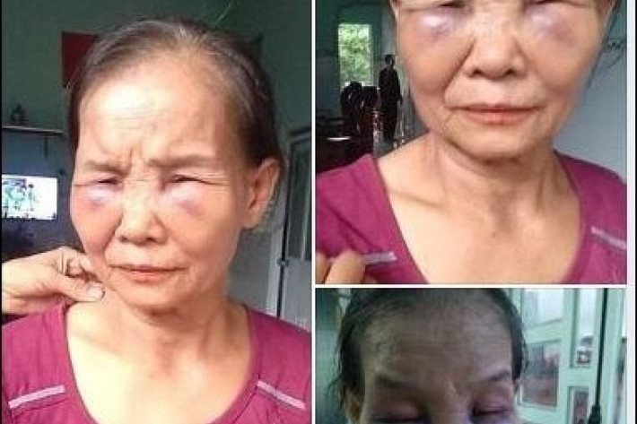 Sáng hôm sau, do quá đau nên bà Tạo nhờ người điện cho các con đến. Lúc này, các con bà Tạo tá hỏa biết sự việc và không khỏi căm phẫn khi nhìn thấy mẹ mình bị nàng dâu bạo hành nên đến trình báo công an, đồng thời chụp ảnh đăng tải lên mạng xã hội. Sáng 3/7, tại cơ quan công an, chị Tr. đã xin lỗi mẹ chồng và viết bản cam kết không tái phạm. Bà Tạo cũng nhận thấy mình có một phần lỗi nhưng chưa chấp nhận cho con dâu về lại nhà ở chung.