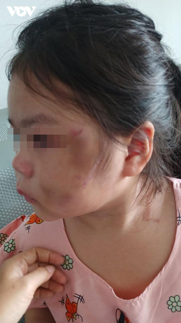  Bố đánh con gái 6 tuổi tím mặt khi dạy học: Ngày 1/10, mạng xã hội chia sẻ hình ảnh kèm bình luận về việc bé gái (6 tuổi) bị chính cha ruột của mình bạo hành dã man. Qua xác minh, nạn nhân là bé L.M.H.Y (6 tuổi). Người bạo hành bé được xác định là ông Lê Quốc Hùng (43 tuổi, cha ruột cùng trú thị xã Bến Cát, tỉnh Bình Dương). Tại chính quyền địa phương, ông Hùng giải thích "lỡ tay" khi dạy bé học online và hứu không tái phạm. 