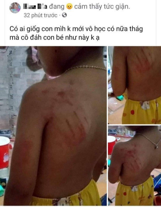 Cô giáo đánh học sinh lớp 1 bầm tím: Chiều 14/9, tại Trường Tiểu học Bàu Lâm (xã Bàu Lâm, huyện Xuyên Mộc, tỉnh Bà Rịa-Vũng Tàu) trong tiết học môn Tiếng Việt. Học sinh này chậm tiếp thu bài giảng, viết bài chậm nên bị cô giáo dùng tay đánh vào tay và vai trái gây vết bầm tím. Sau khi nắm được thông tin, Ban Giám hiệu đã tổ chức họp hội đồng xử lý kỷ luật đối với giáo viên này. Được biết, giáo viên sau đó cũng trực tiếp xin lỗi gia đình, phía gia đình cũng chấp nhận, hiện sức khỏe cháu đã ổn định.