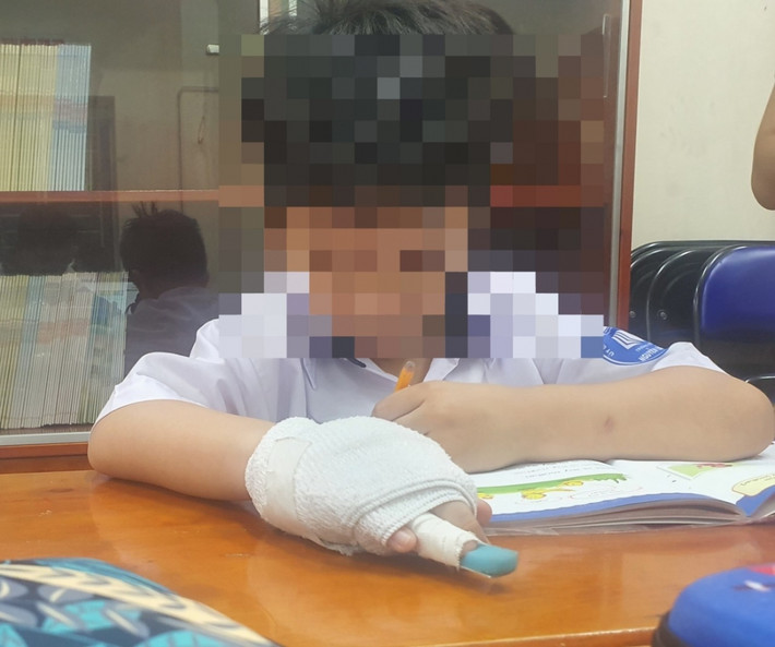 Cô giáo đánh gãy ngón tay học sinh: Chiều 4/10/2023, bé M.K học sinh lớp 1 tại Tiểu học Nguyễn Văn Trỗi ( quận Tân Bình, TP HCM) khi đi học về kêu bị đau nhức ngón tay. Ba mẹ kiểm tra thì thấy bàn tay bên phải của con có hiện tượng sưng. Bé kể bị cô giáo chủ nhiệm đánh bằng cây gõ nhạc cụ vào mu bàn tay trong tiết học buổi sáng. Sau khi đi khám, bé được kết luận bị gãy xương ngón tay ở bàn tay phải. Sở GD&ĐT TP HCM đã yêu cầu Phòng GD&ĐT quận Tân Bình phối hợp với hiệu trưởng xử lý nghiêm và tổ chức kiểm điểm, kỷ luật giáo viên này.