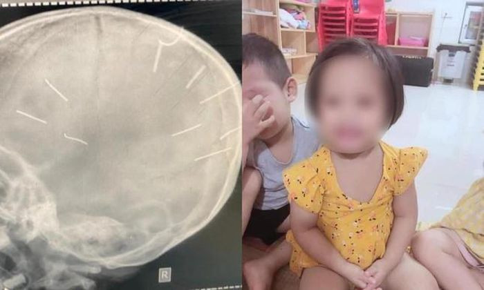 Sức khỏe bé gái bị găm 9 đinh vào đầu giờ ra sao?: Ngày 24/2, người thân của bé gái Đ.N.A (4 tuổi, trú tại Canh Nậu, Thạch Thất, Hà Nội) bị người tình của mẹ là Nguyễn Trung Huyên (30 tuổi, trú cùng huyện) bạo hành, găm 9 chiếc đinh vào đầu cho biết, nạn nhân vẫn chưa được phẫu thuật và trong tình trạng hôn mê đang được điều trị tích cực tại Khoa Hồi sức cấp cứu Nhi, Bệnh viện Đa khoa Xanh Pôn.