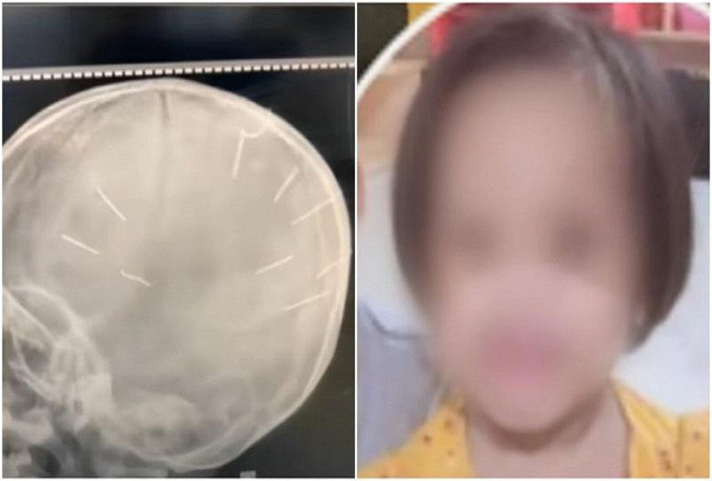 Bệnh viện đa khoa huyện Thạch Thất đã tiến hành sơ cứu, chụp X-quang, chụp cắt lớp vi tính phát hiện có 9 dị vật xuyên xương đỉnh hai bên vào nhu mô não, nên chuyển cháu Ánh đến Bệnh viện đa khoa Xanh Pôn tiếp tục cấp cứu. Đến ngày 12/3/2022, bé gái tử vong. Theo cơ quan truy tố, người thân cháu Đỗ Ngọc Ánh đề nghị pháp luật xử lý nghiêm minh hành vi của Nguyễn Trung Huyên. Đối với chị Nguyễn Thị Luyến, các lần Huyên hành hạ, đánh và giết cháu Ánh, chị này không biết nên không là đồng phạm.