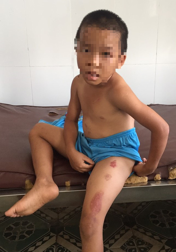 Bé trai 6 tuổi bị cha dượng bạo hành dã man: Ngày 21/4, sau khi đi nhậu về, Nguyễn Hoàng Vũ (41 tuổi, ngụ huyện Mỹ Xuyên, tỉnh Sóc Trăng) dùng dao Thái Lan gây thương tích ở ngực phải, bả vai trái của cháu N.T.H. (6 tuổi). Trước đó, Vũ đã 5 lần lấy thuốc lá đang cháy châm vào nhiều vị trí trên cơ thể của cháu H. như mặt, đùi, háng... Sau đó, Vũ bị Công an tạm giữ để điều tra.