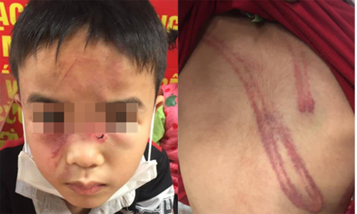 Bé trai 7 tuổi bị cha bạo hành tại Hà Nội: Đầu tháng 2/2021, một bé trai con chị Nguyễn Thị H. (trú phường Sài Đồng, quận Long Biên) được người dân phát hiện có nhiều thương tích trên người. Khi được hỏi cháu bé cho biết bị bố đánh lúc mẹ vắng nhà. Công an phường Sài Đồng cho biết, cháu bé bị cha đánh vì lấy trộm tiền.