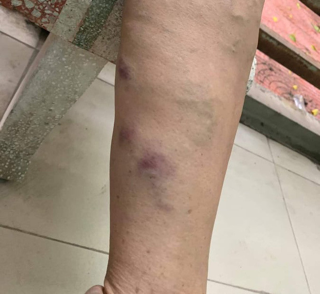 Chị Đào chị hay: “Hiện tại, mẹ và dì tôi vẫn đang phải điều trị tại bệnh viện. Sau khi xảy ra sự việc, tôi đã trình báo lên Công an xã Hồng Hà, Công an huyện Đan Phượng để nhờ cơ quan chức năng vào cuộc làm rõ, có biện pháp bảo vệ người dân địa phương. Phía Công an cũng đã làm việc, lấy lời khai của tôi và gia đình”.