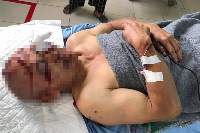 4. Nhân viên đang ngủ bị cướp chém trọng thương: Rạng sáng 29/8, ông Quách Văn Dĩnh (SN 1967, quê Hòa Bình) đang ngủ tại quán giải khát Hòa Bình, khu du lịch Quốc gia hồ Tuyền Lâm (TP Đà Lạt) thì bất ngờ bị một đối tượng xông vào chém tới tấp. Tại cơ quan điều tra, tên cướp khai là Nguyễn Công Phúc (SN 2000, quê Bình Định), do làm ăn thua lỗ không có tiền trả nợ nên đã ra ra tay sát hại ông Dĩnh để cướp tài sản.