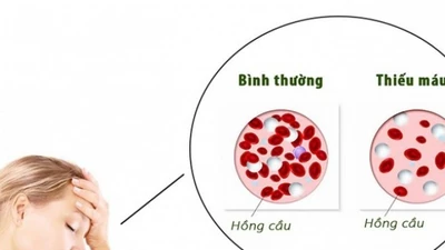 Bác sĩ Bệnh viện Bạch Mai chỉ rõ 6 dấu hiệu cảnh báo bệnh về máu