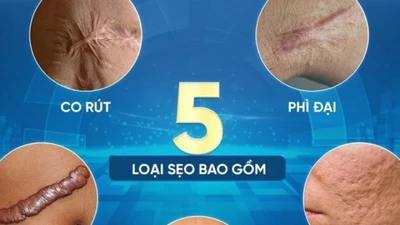 Sửa sẹo căng mô bề mặt: Giải pháp y khoa hiện đại cho làn da sẹo lồi, rỗ, sần sùi tại phòng khám PD de Paris