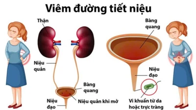 Nhiễm trùng tiết niệu tiền mãn kinh, hiểu để bảo vệ sức khỏe từ gốc