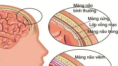50% nhiễm trùng huyết do não mô cầu tử vong, cách gì phòng tránh