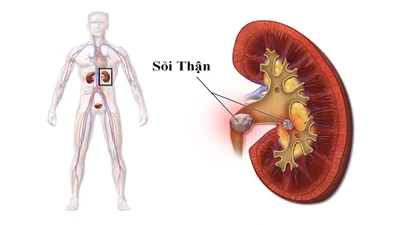 Địa chỉ vàng: Các bệnh viện điều trị sỏi thận tốt tại Hà Nội