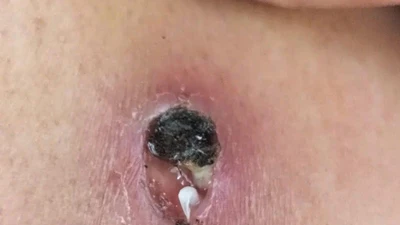 Giun rồng 1 mét chui ra từ người đàn ông 44 tuổi, cách phòng bệnh